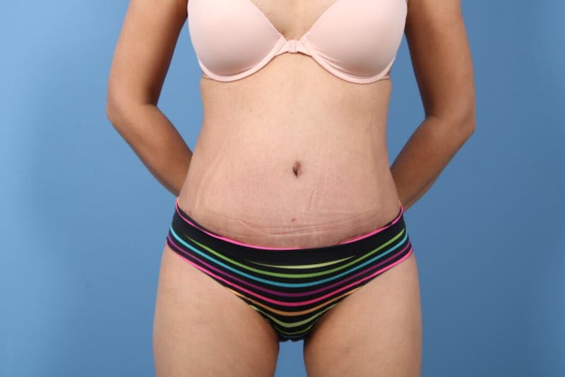 Tummy Tuck Before & After Gallery - Patient 324112 - Image 2