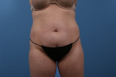 Tummy Tuck Before & After Gallery - Patient 314150 - Image 1