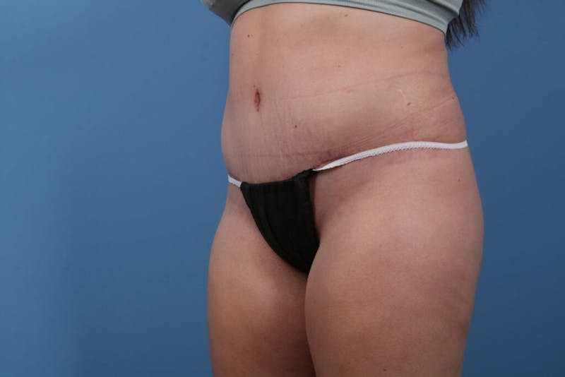 Tummy Tuck Before & After Gallery - Patient 314150 - Image 4