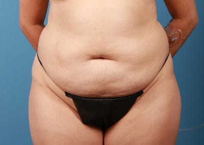 Tummy Tuck Before & After Gallery - Patient 469315 - Image 1