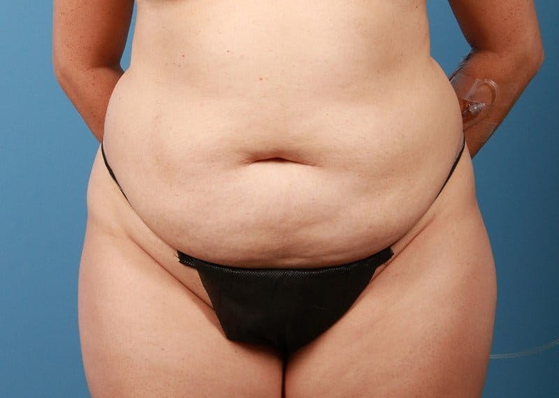 Tummy Tuck Before & After Gallery - Patient 469315 - Image 1