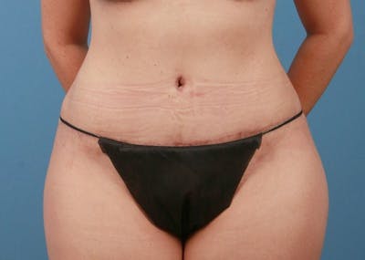Tummy Tuck Before & After Gallery - Patient 469315 - Image 2