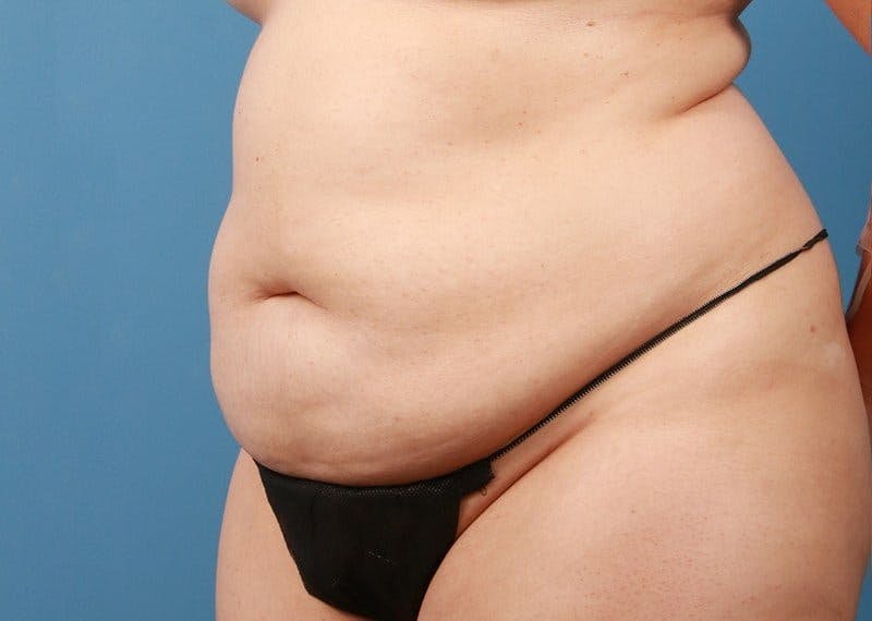 Tummy Tuck Before & After Gallery - Patient 469315 - Image 3