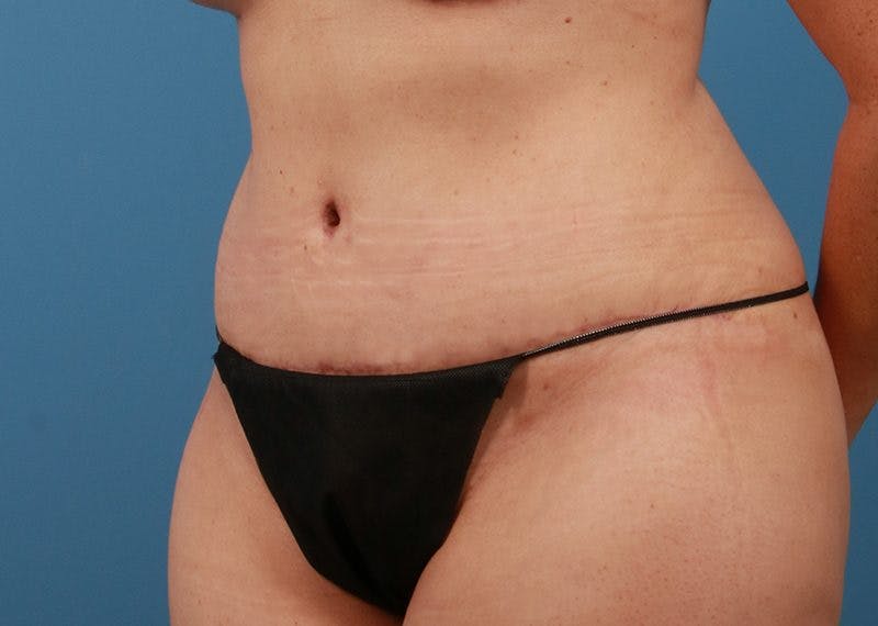 Tummy Tuck Before & After Gallery - Patient 469315 - Image 4