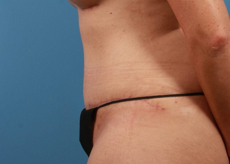 Tummy Tuck Before & After Gallery - Patient 469315 - Image 6
