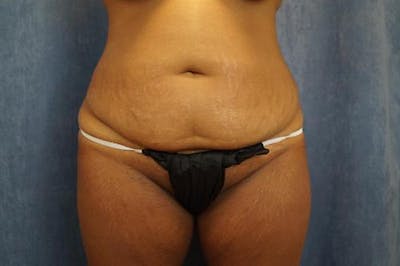Tummy Tuck Before & After Gallery - Patient 981386 - Image 1