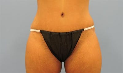 Tummy Tuck Before & After Gallery - Patient 981386 - Image 2