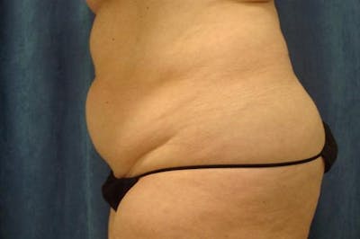 Tummy Tuck Before & After Gallery - Patient 748933 - Image 1