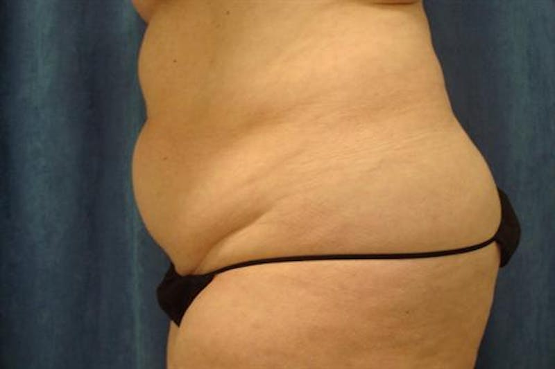 Tummy Tuck Before & After Gallery - Patient 748933 - Image 1