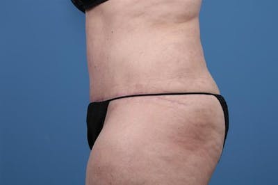 Tummy Tuck Before & After Gallery - Patient 748933 - Image 2
