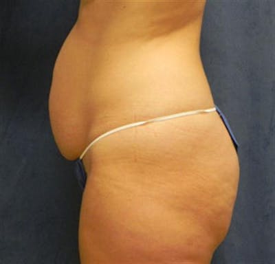 Tummy Tuck Before & After Gallery - Patient 253120 - Image 1