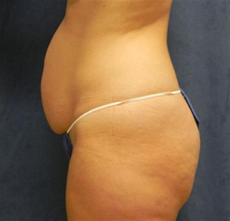 Tummy Tuck Before & After Gallery - Patient 253120 - Image 1