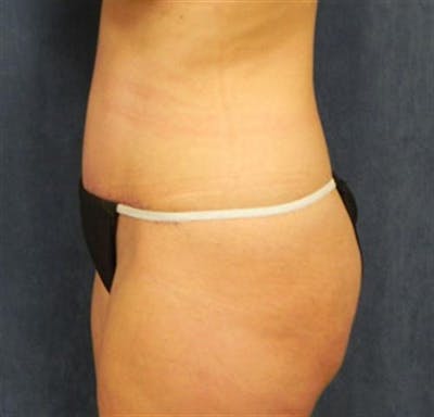 Tummy Tuck Before & After Gallery - Patient 253120 - Image 2
