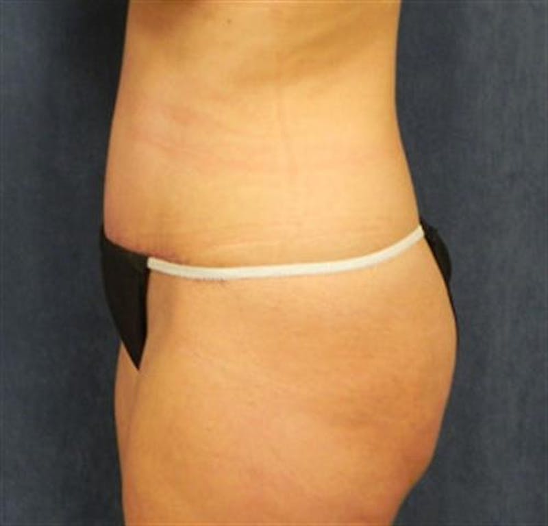 Tummy Tuck Before & After Gallery - Patient 253120 - Image 2