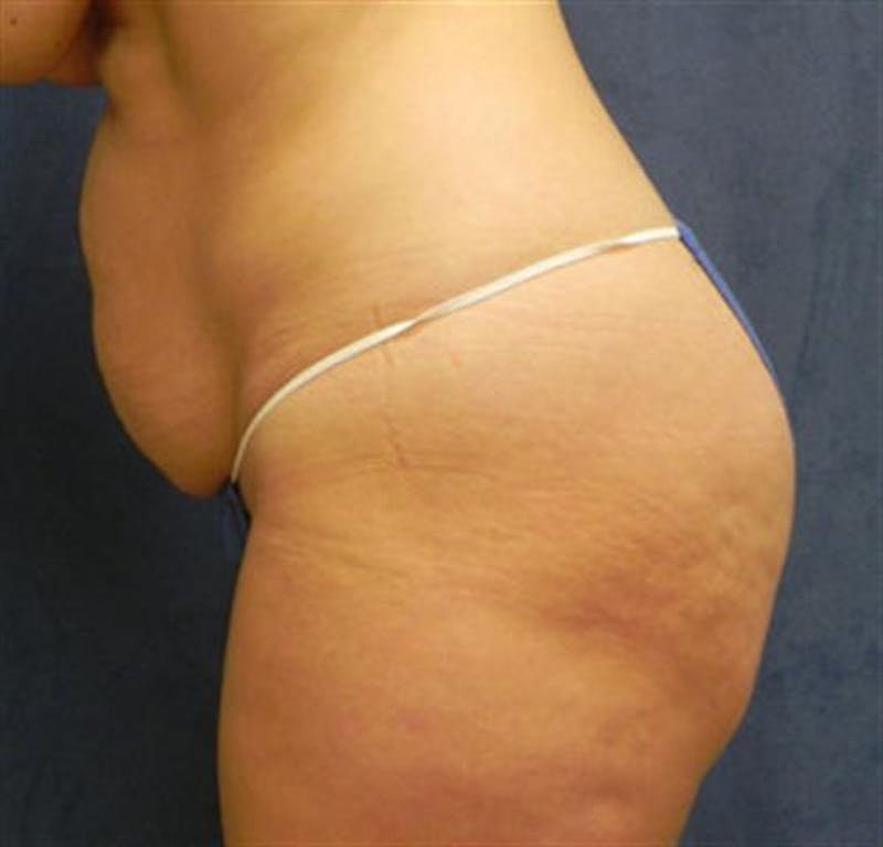 Tummy Tuck Before & After Gallery - Patient 253120 - Image 3