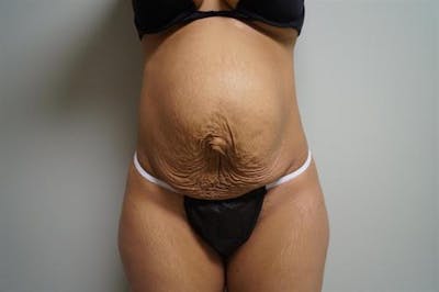Tummy Tuck Before & After Gallery - Patient 298547 - Image 1