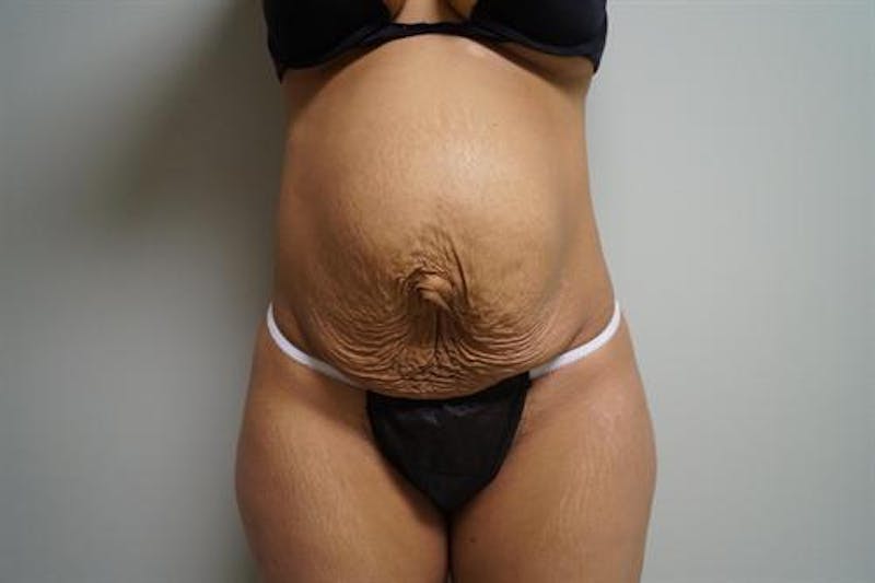 Tummy Tuck Before & After Gallery - Patient 298547 - Image 1