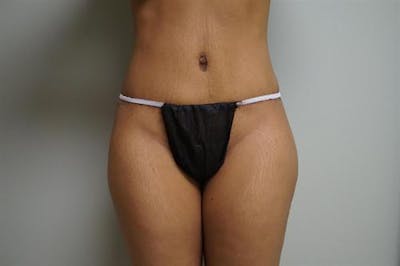 Tummy Tuck Before & After Gallery - Patient 298547 - Image 2