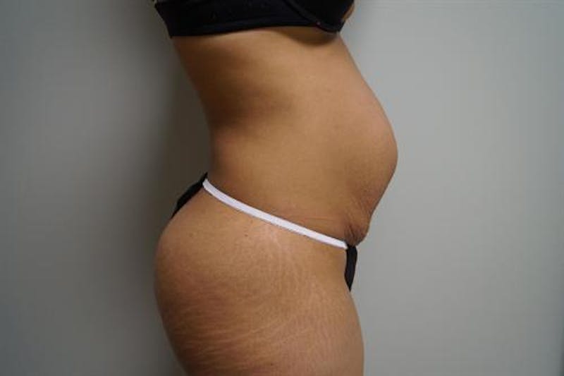 Tummy Tuck Before & After Gallery - Patient 298547 - Image 3