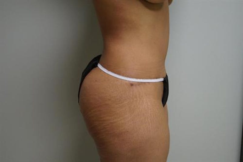 Tummy Tuck Before & After Gallery - Patient 298547 - Image 4