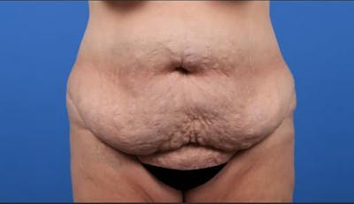 Tummy Tuck Before & After Gallery - Patient 247235 - Image 1