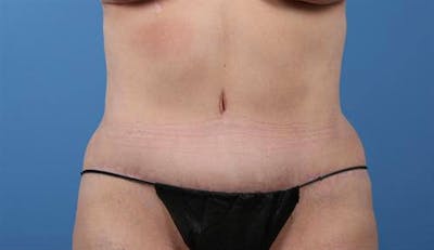 Tummy Tuck Before & After Gallery - Patient 247235 - Image 2