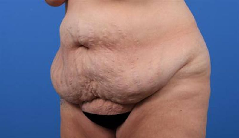 Tummy Tuck Before & After Gallery - Patient 247235 - Image 3