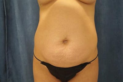 Tummy Tuck Before & After Gallery - Patient 418566 - Image 1