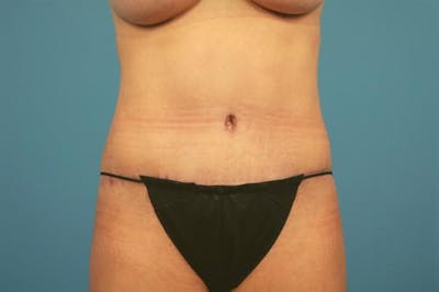 Tummy Tuck Before & After Gallery - Patient 418566 - Image 2