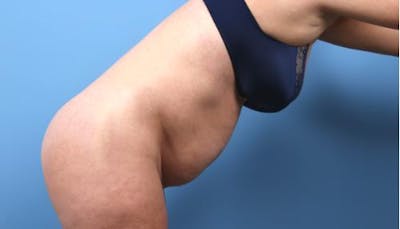 Tummy Tuck Before & After Gallery - Patient 352681 - Image 1