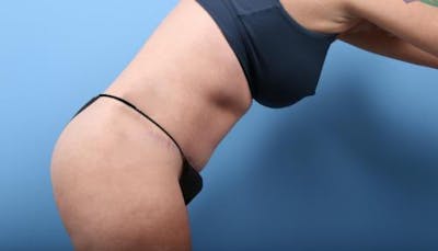 Tummy Tuck Before & After Gallery - Patient 352681 - Image 2
