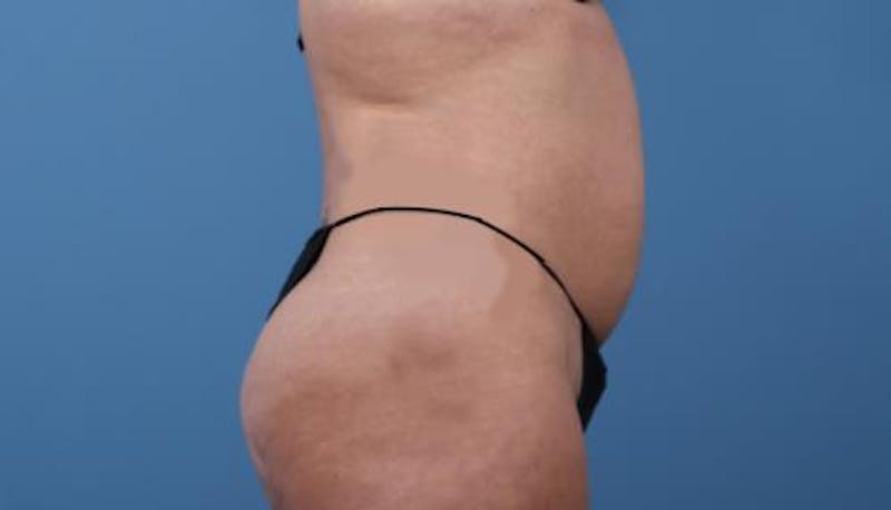 Tummy Tuck Before & After Gallery - Patient 352681 - Image 3