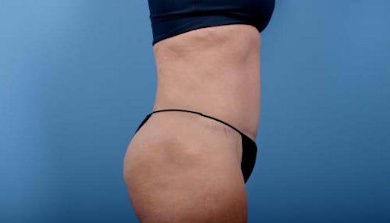 Tummy Tuck Before & After Gallery - Patient 352681 - Image 4