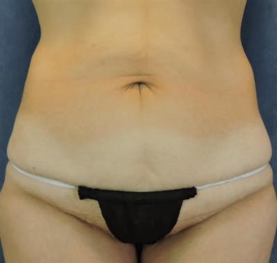 Tummy Tuck Before & After Gallery - Patient 147369 - Image 1