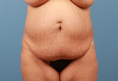 Tummy Tuck Before & After Gallery - Patient 361535 - Image 1