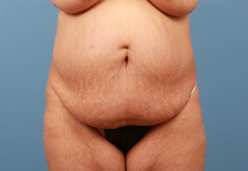 Tummy Tuck Before & After Gallery - Patient 361535 - Image 1