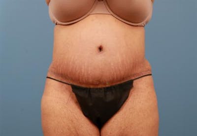 Tummy Tuck Before & After Gallery - Patient 361535 - Image 2