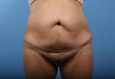 Tummy Tuck Before & After Gallery - Patient 575839 - Image 1