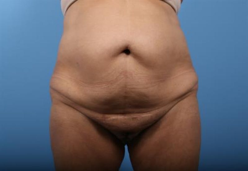 Tummy Tuck Before & After Gallery - Patient 575839 - Image 1