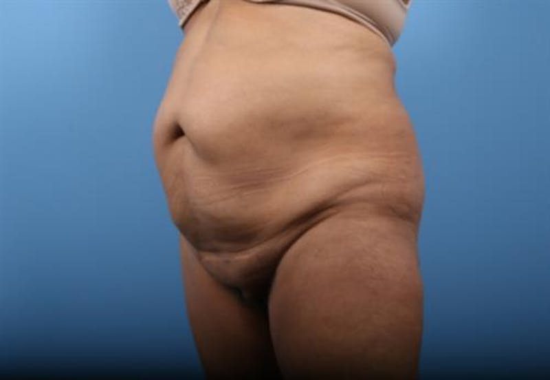 Tummy Tuck Before & After Gallery - Patient 575839 - Image 3