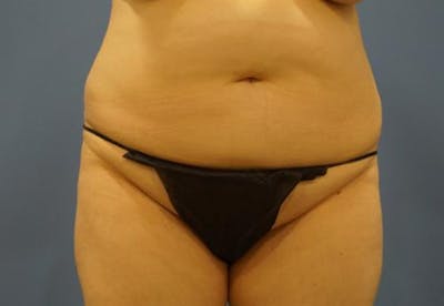 Tummy Tuck Before & After Gallery - Patient 192839 - Image 1