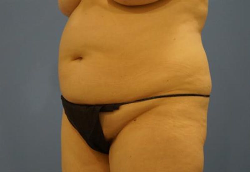 Tummy Tuck Before & After Gallery - Patient 192839 - Image 3