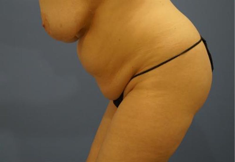 Tummy Tuck Before & After Gallery - Patient 192839 - Image 7