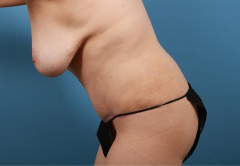 Tummy Tuck Before & After Gallery - Patient 192839 - Image 8