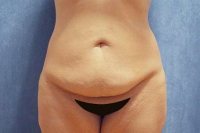 Tummy Tuck Before & After Gallery - Patient 505895 - Image 1