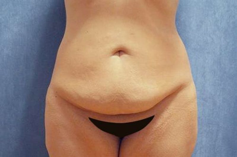 Tummy Tuck Before & After Gallery - Patient 505895 - Image 1