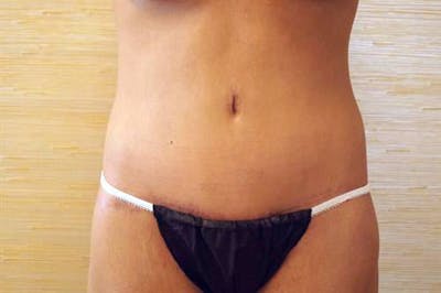 Tummy Tuck Before & After Gallery - Patient 505895 - Image 2