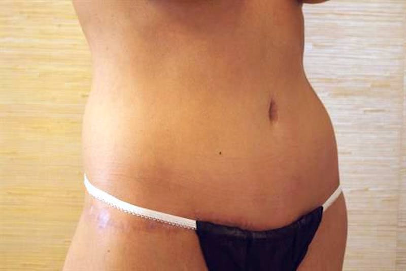 Tummy Tuck Before & After Gallery - Patient 505895 - Image 4
