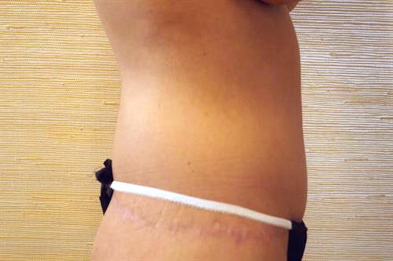 Tummy Tuck Before & After Gallery - Patient 505895 - Image 6