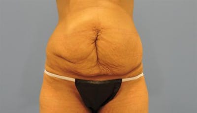 Tummy Tuck Before & After Gallery - Patient 150475 - Image 1